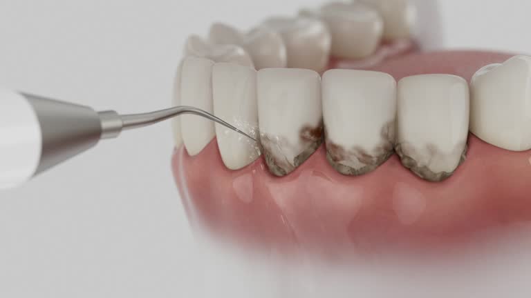 Trusted Wisdom Tooth Removal service in West Valley City, UT - Dentist Open Now